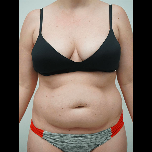 liposuction before and afters