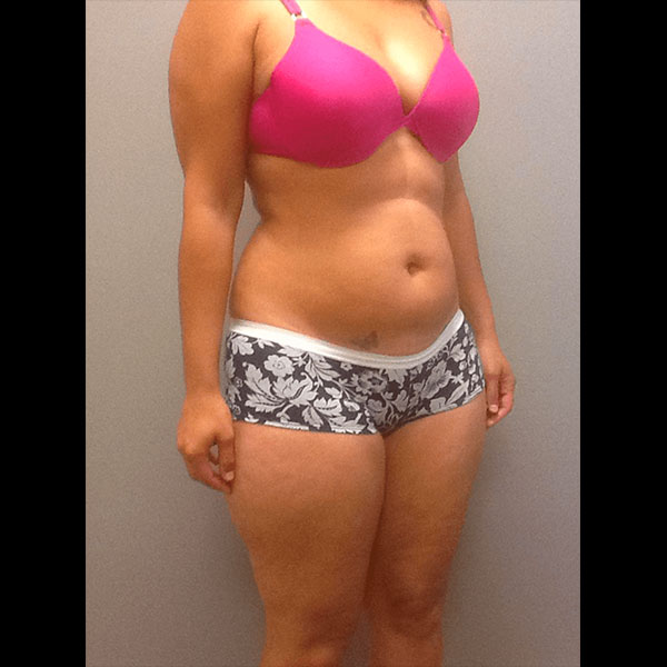 liposuction before and afters