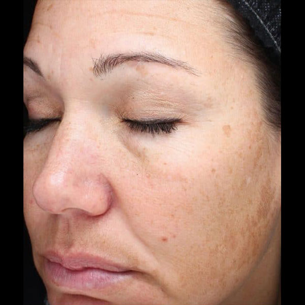 photofacial before and afters
