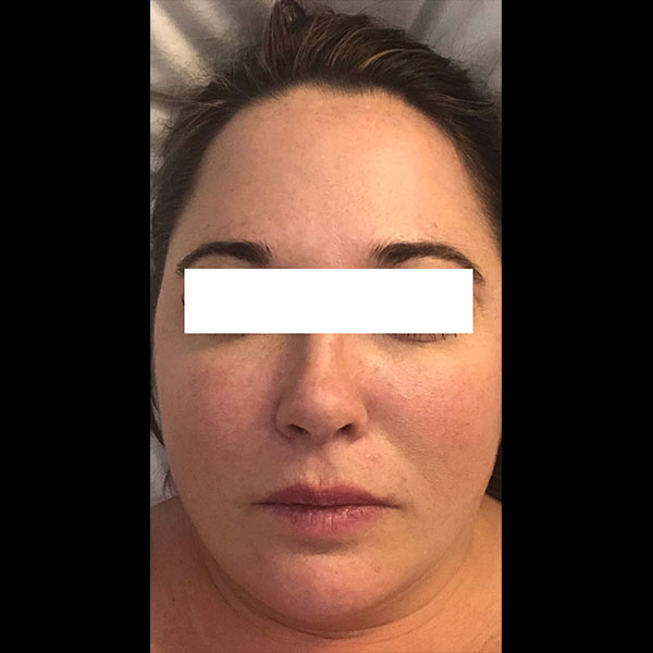 photofacial before and afters