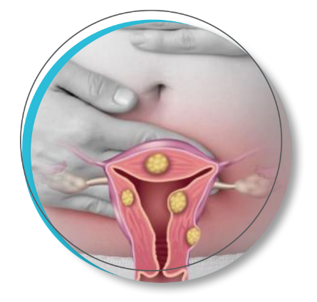 Sonata Treatment For Transcervical Fibroid Ablation